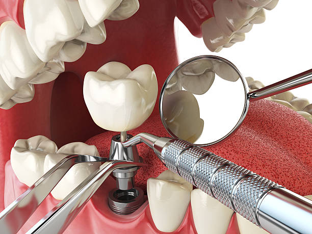 Best Broken Tooth Emergency  in Bloomville, OH